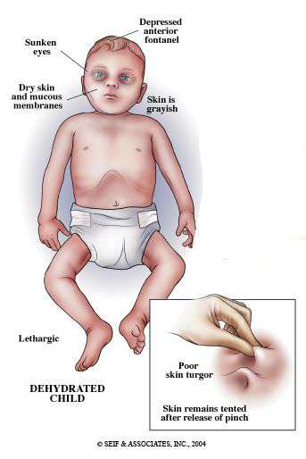 أعراض الجفاف عند الأطفال و الرضع
