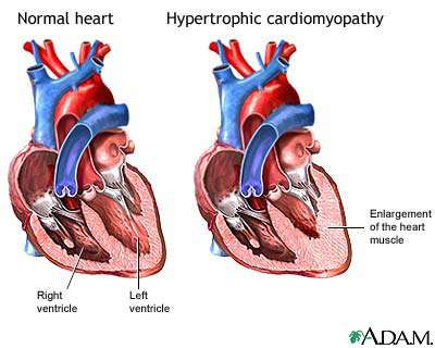 اعتلال وضعف العضلة القلبية الضخامي او التضخمي