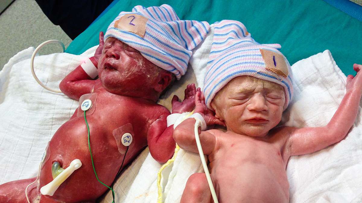 الأنيميا و فقر الدم عند الأطفال حديثي الولادة