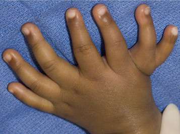 التضاعف المركزي للأصابع عند الاطفال