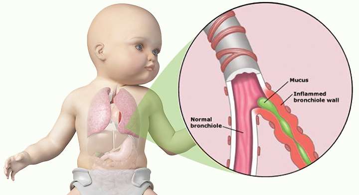 التهاب الشعيبات الهوائية التنفسية عند الطفل الرضيع
