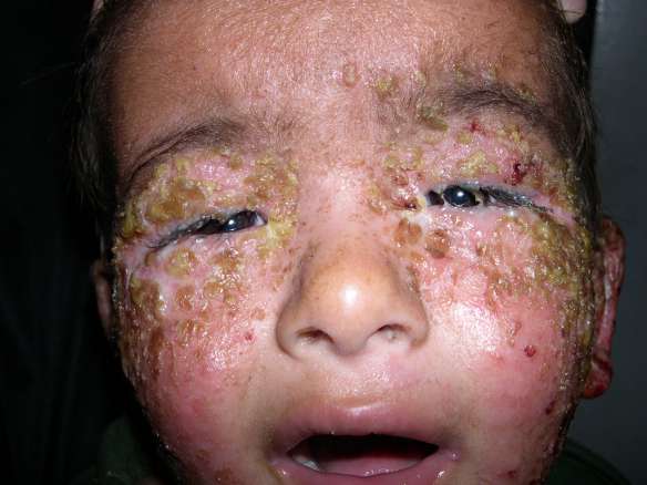 التهابات الجلد البكتيرية عند الاطفال