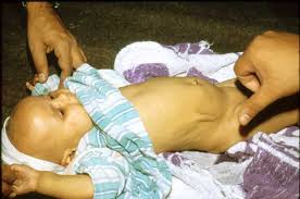الجفاف او التجفاف عند الاطفال و الرضع