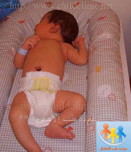 اليرقان الولادي :اسباب ,اعراض ,تشخيص ,معالجة