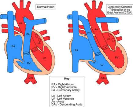 تبادل منشأ الأوعية أو الشرايين الكبيرة في القلب عند الاطفال