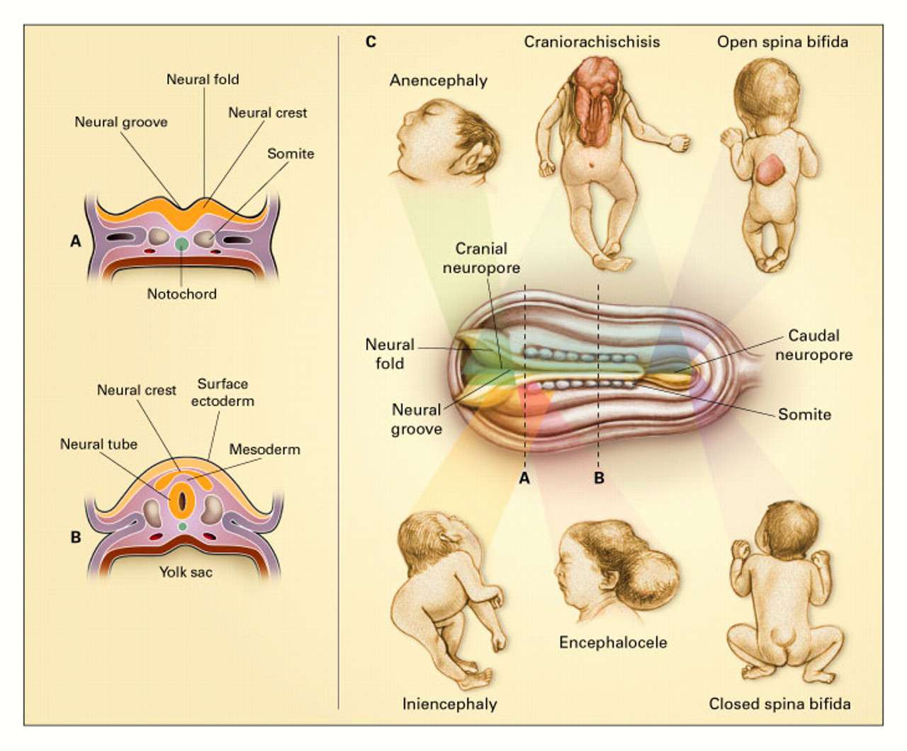 تشوهات الجهاز العصبي عند الأطفال حديثي الولادة