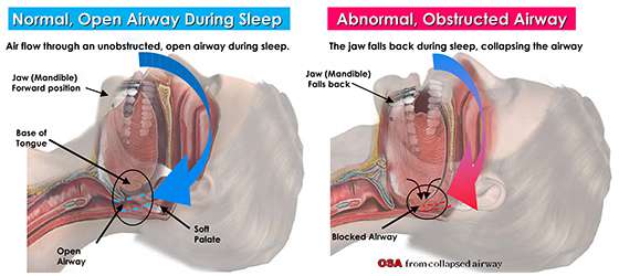 توقف الطفل والرضيع عن التنفس خلال النوم