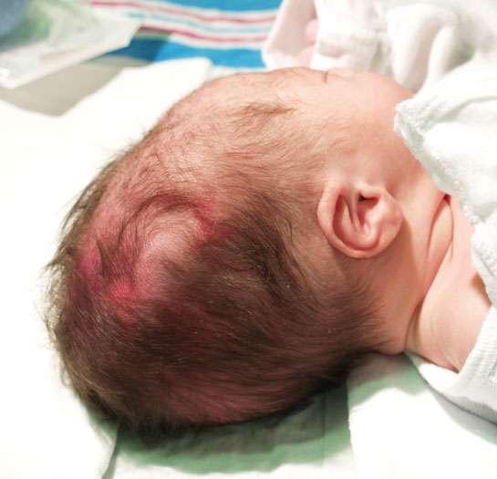 حدبة مصلية دموية عند طفل حديث الولادة