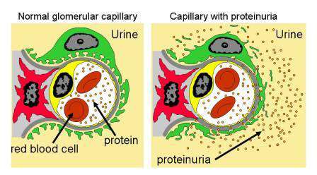 زيادة البروتين و الزلال في البول