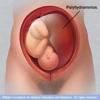 زيادة الماء حول الجنين