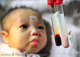 فقر الدم عند الطفل حديث الولادة