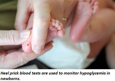 نقص السكر في الدم عند الأطفال حديثي الولادة