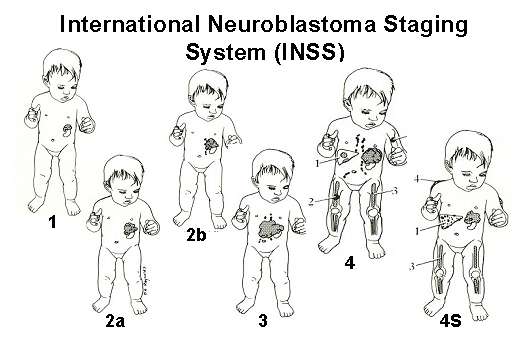 ورم النوروبلاستوما عند الأطفال و الرضع