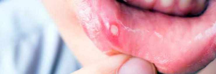 أسباب التهاب الفم القلاعي