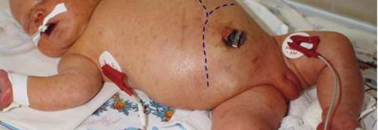 أعراض و علاج التهابات و انتانات الأطفال حديثي الولادة