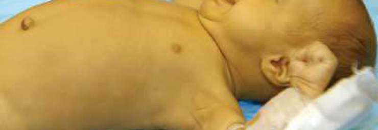 أعراض و علامات مرض الطفل المولود حديث الولادة