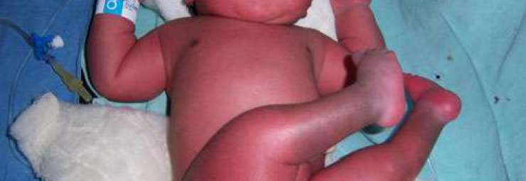 احمرار الدم و كثرة الكريات الحمر عند حديث الولادة