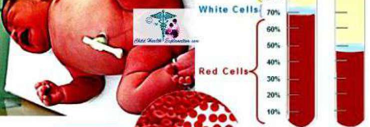 اسباب ارتفاع كريات الدم الحمراء عند الأطفال و المواليد
