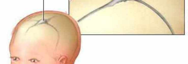 تشخيص نزيف الدماغ عند الطفل الخديج