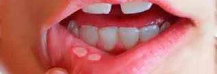 التهاب الفم القلاعي
