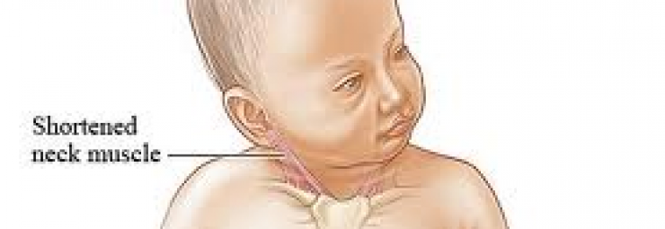 الصعر و ميلان رأس الطفل حديث الولادة نحو احد الجانبين