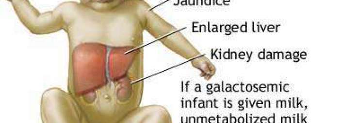 الغالاكتوزيميا عند الاطفال