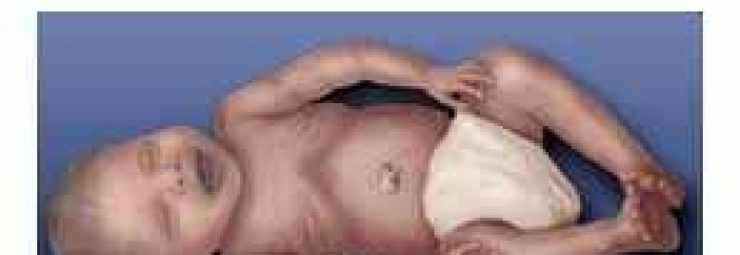زرقة الطفل عند الولادة