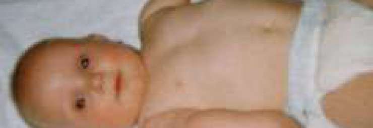 شلل إرب :رخاوة الذراع عند المولود بعد الولادة
