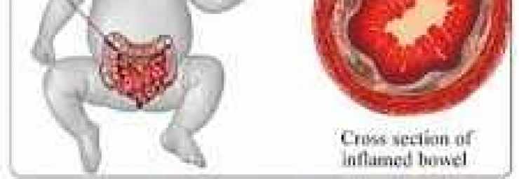 علاج التهاب الأمعاء والكولون النخري عند الوليد