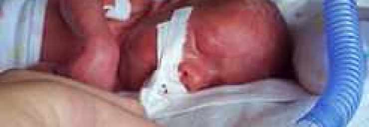 علاج استنشاق العقي عند الطفل حديث الولادة
