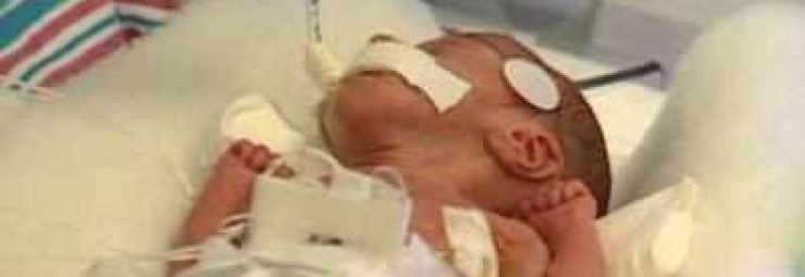 اسباب متلازمة الضائقة التنفسية عند الخدج و حديثي الولادة