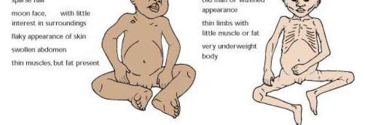 سوء التغذية عند الرضع و الأطفال