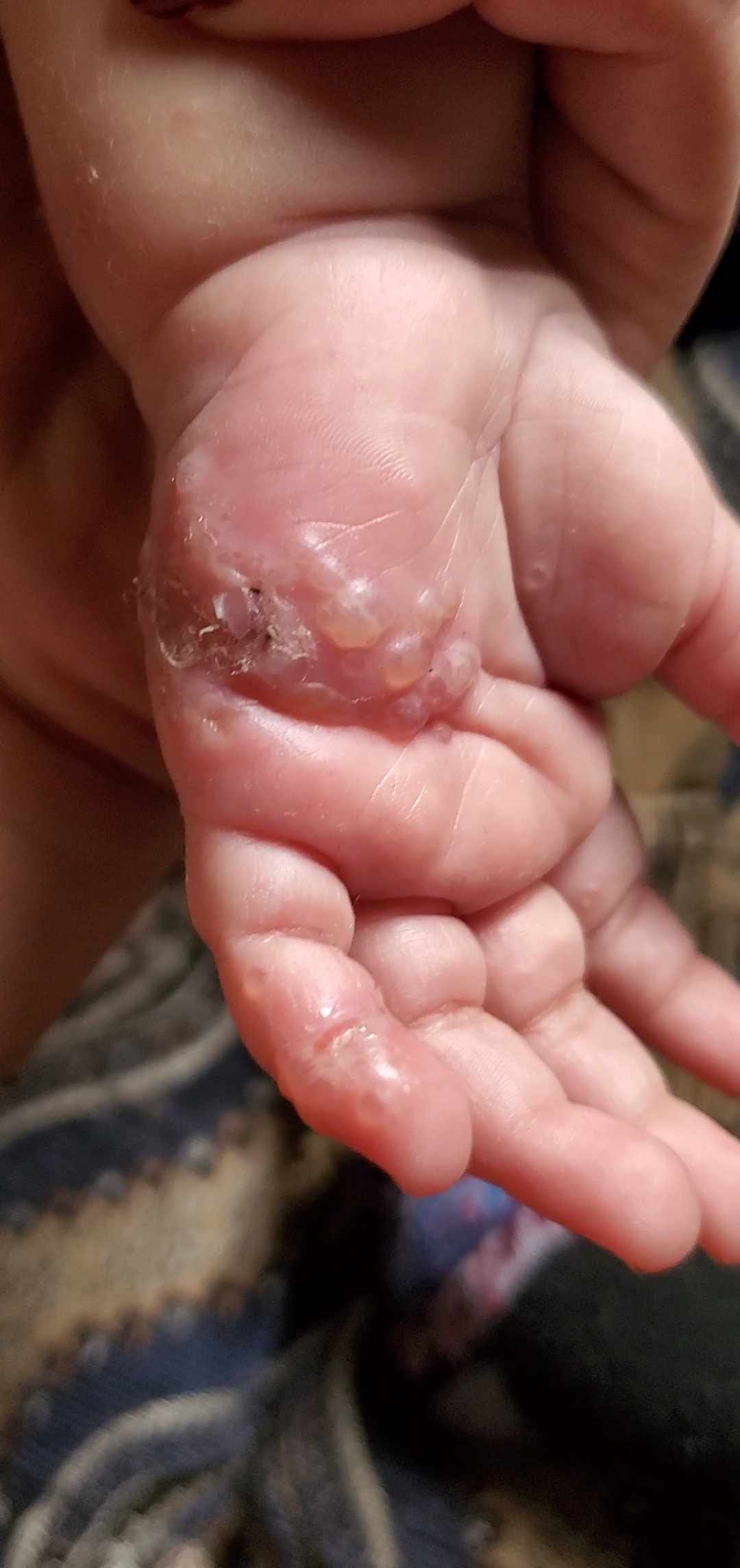 علاج فقاعات الجلد في اليد