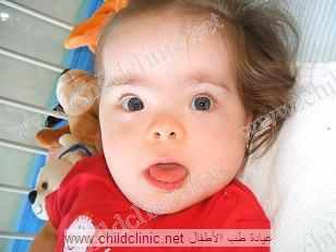 امساك مستمر لدى طفل متلازمة داون