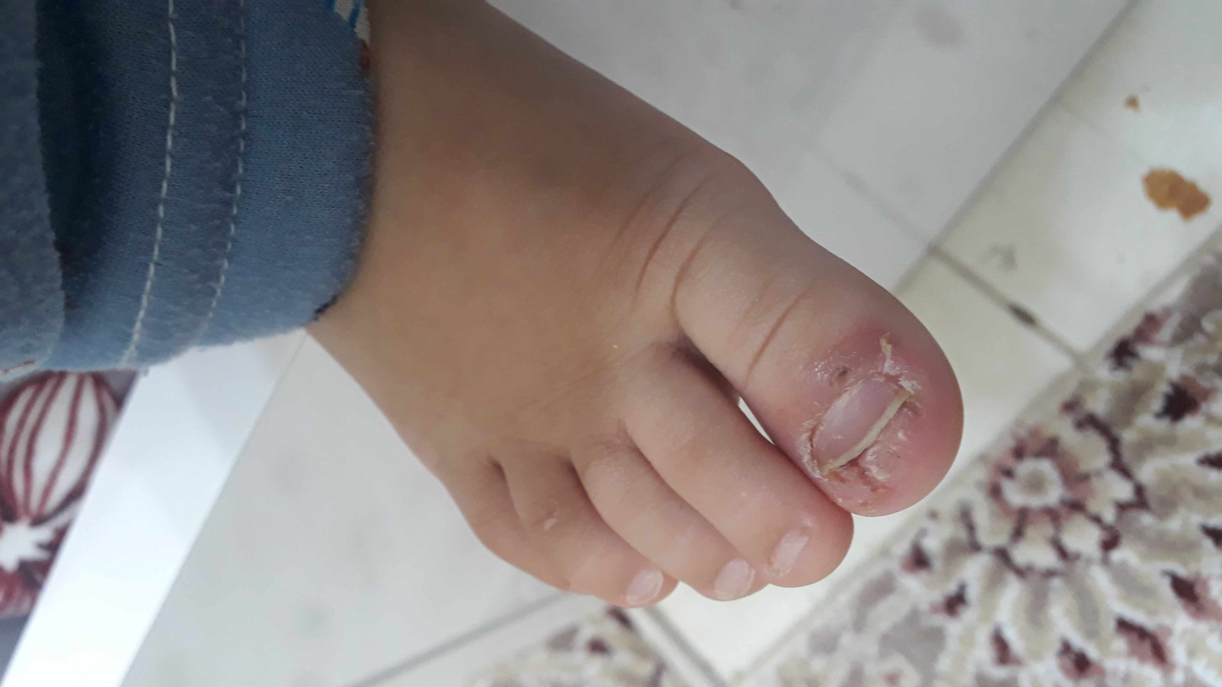 علاج تقشر جلد الأصابع عند الأطفال