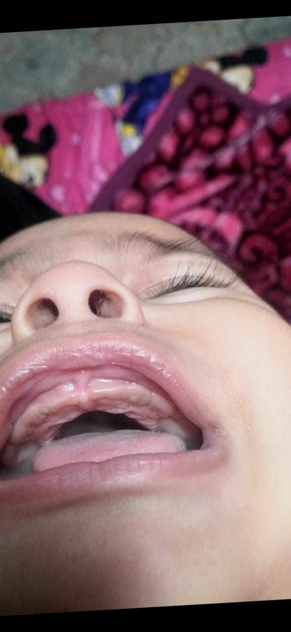 لثة الرضيع عند التسنين