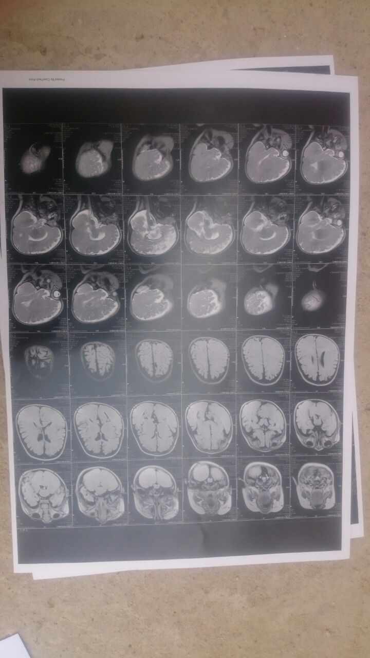 تشخيص ضمور الدماغ للطفل