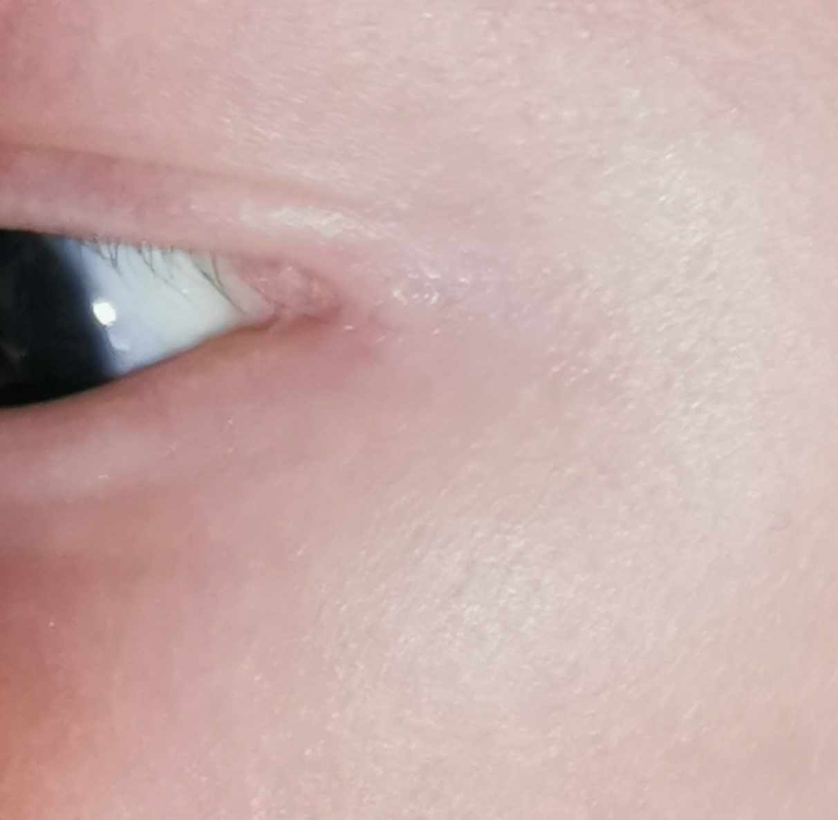 طية جلد في جفن العين
