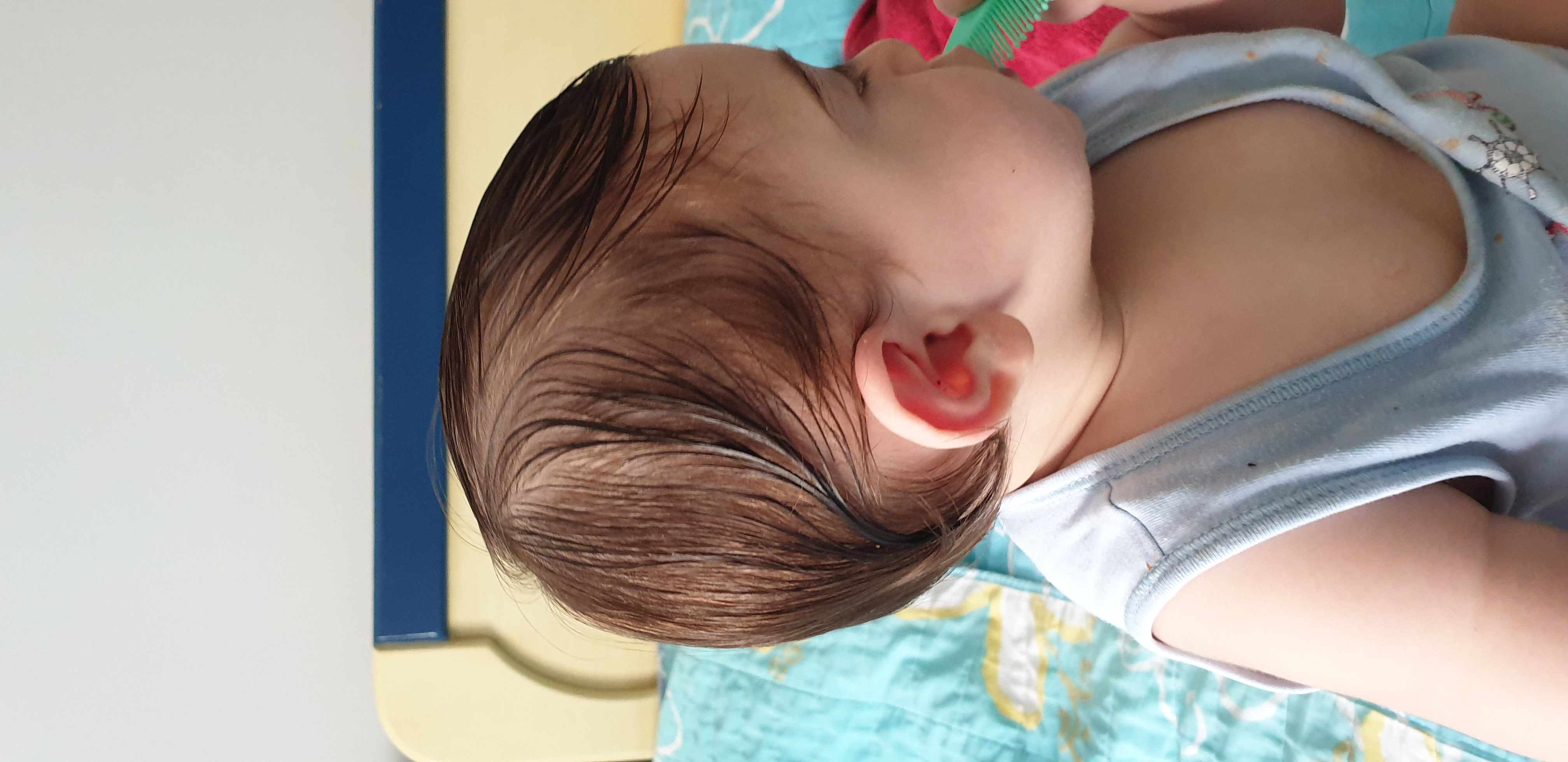 علاج و تعديل تسطح رأس الطفل بالخوذة