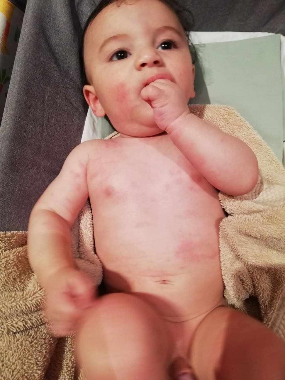 طفلي عنده حساسية على الجلد