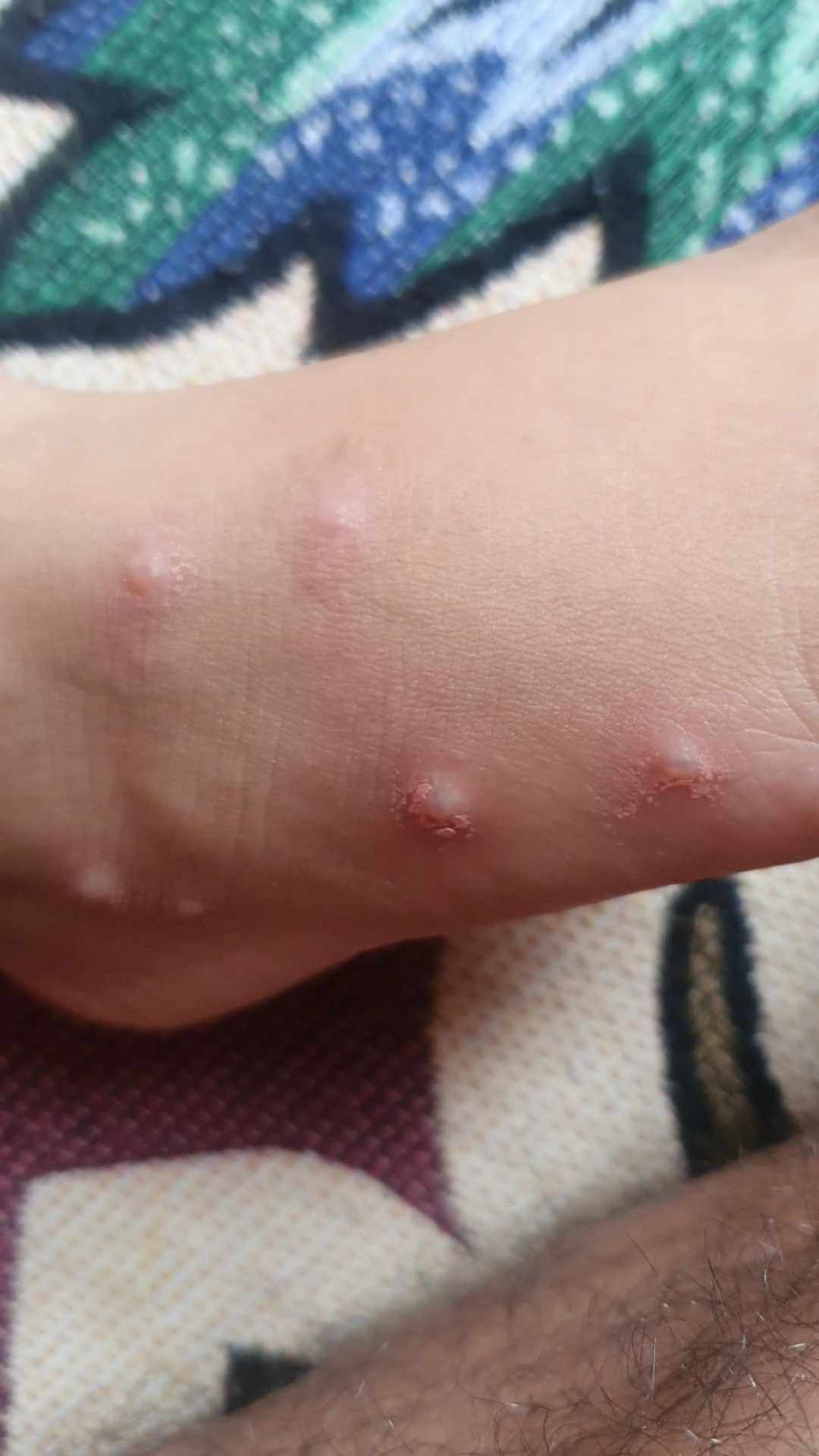 حبوب حساسية الحشرات