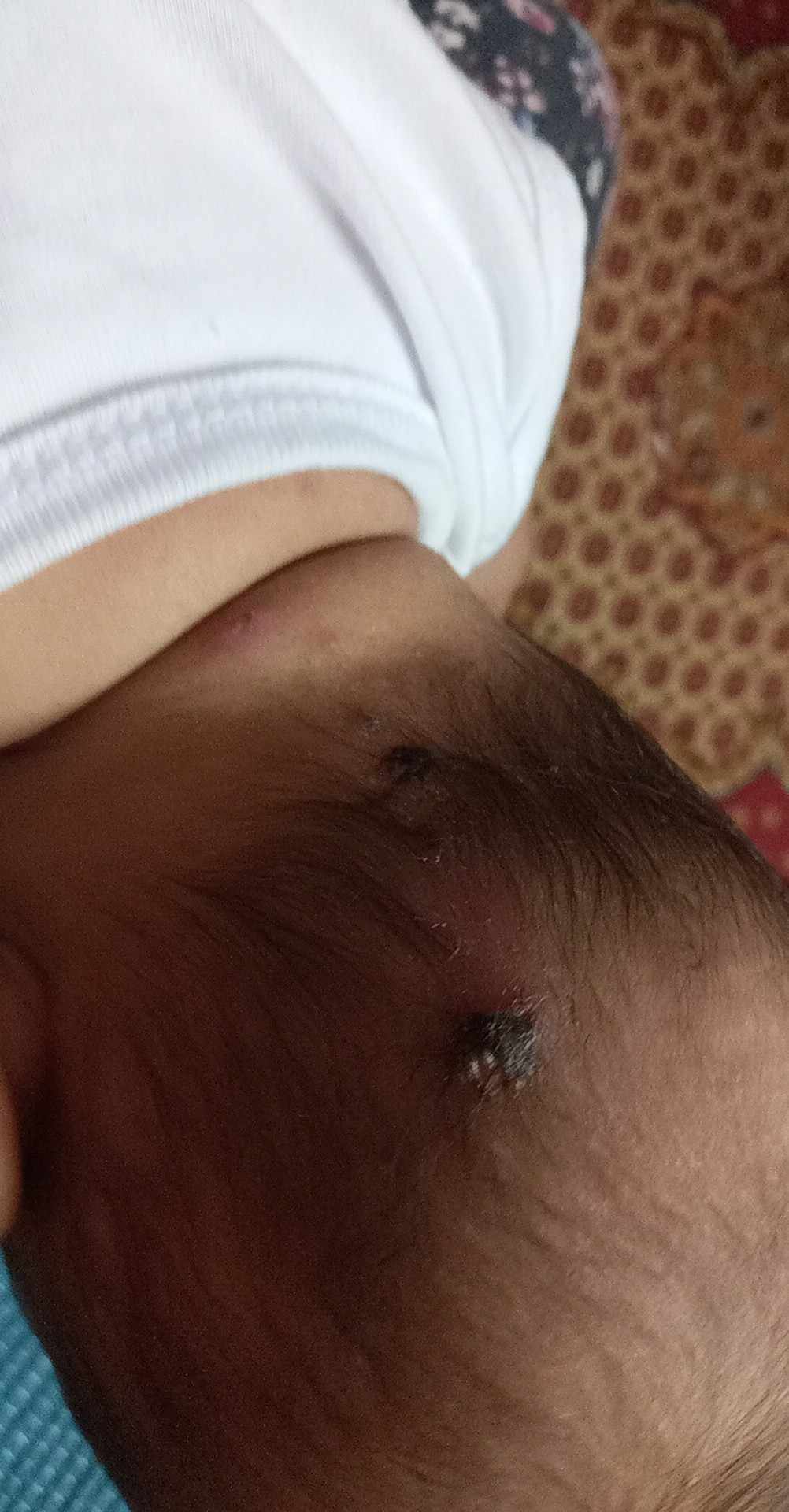 قوباء الاطفال بالصور