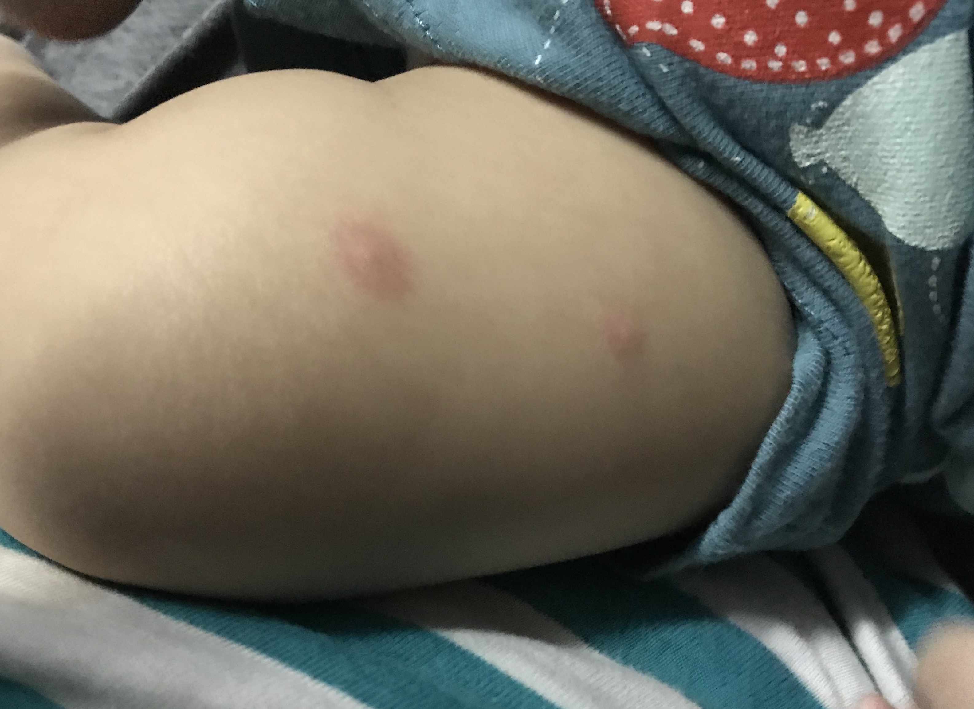 حبوب ظهرت فجأه على رجل الطفل