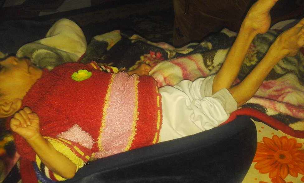 ضمور في مخ الطفل