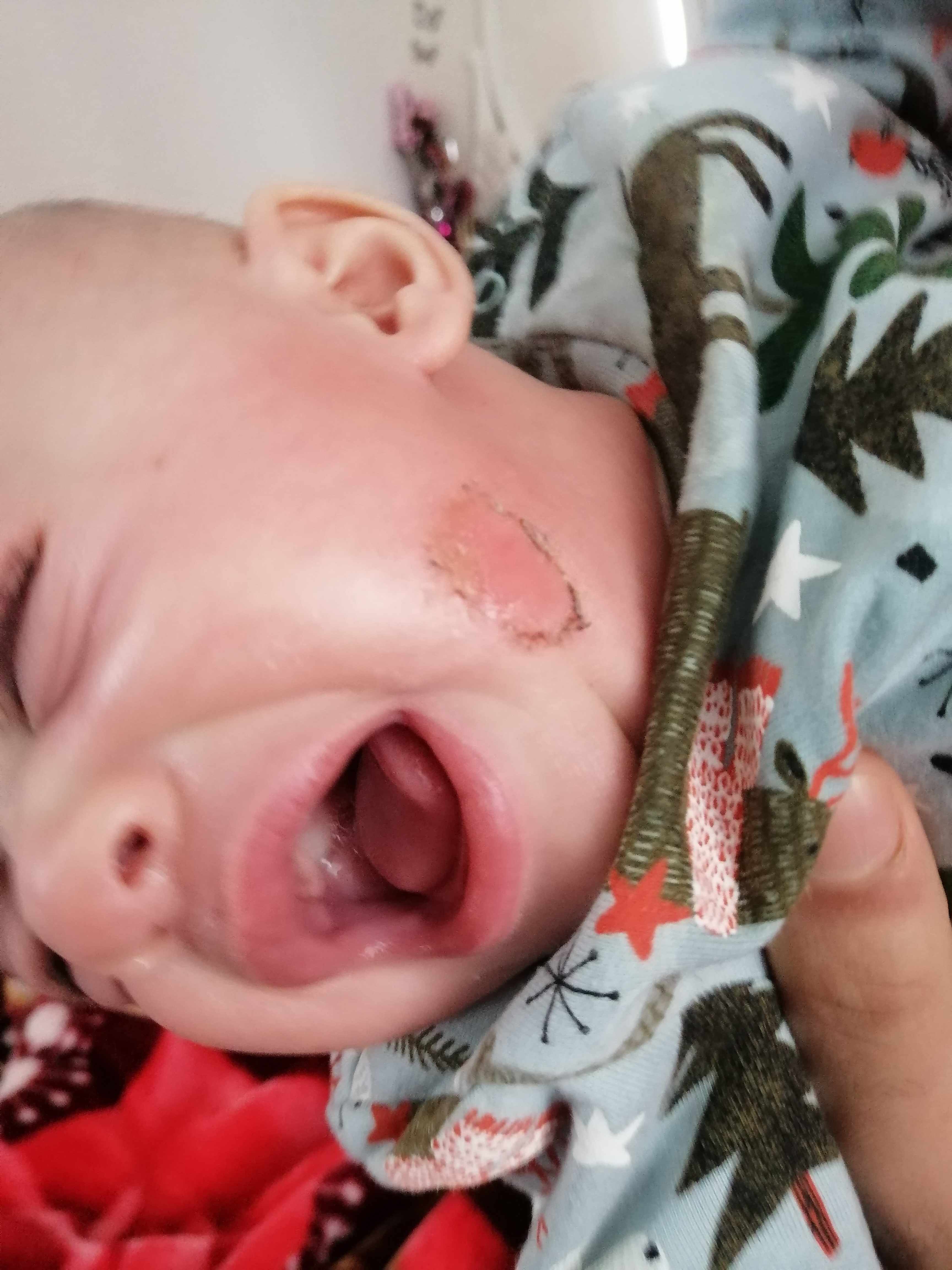 حبة تنز ماء عند الطفل