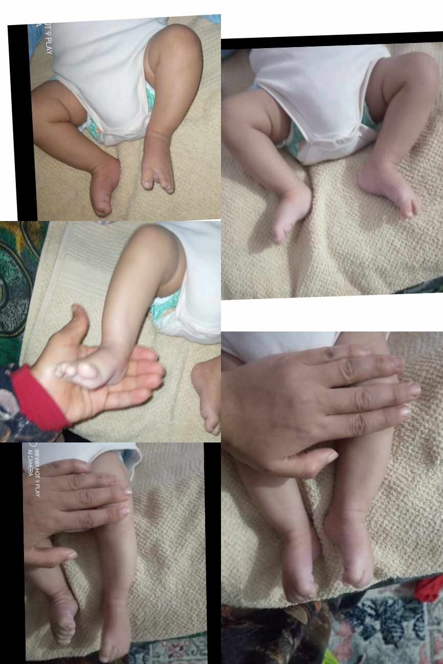 التفاف القدم عند الأطفال: 9 أسباب