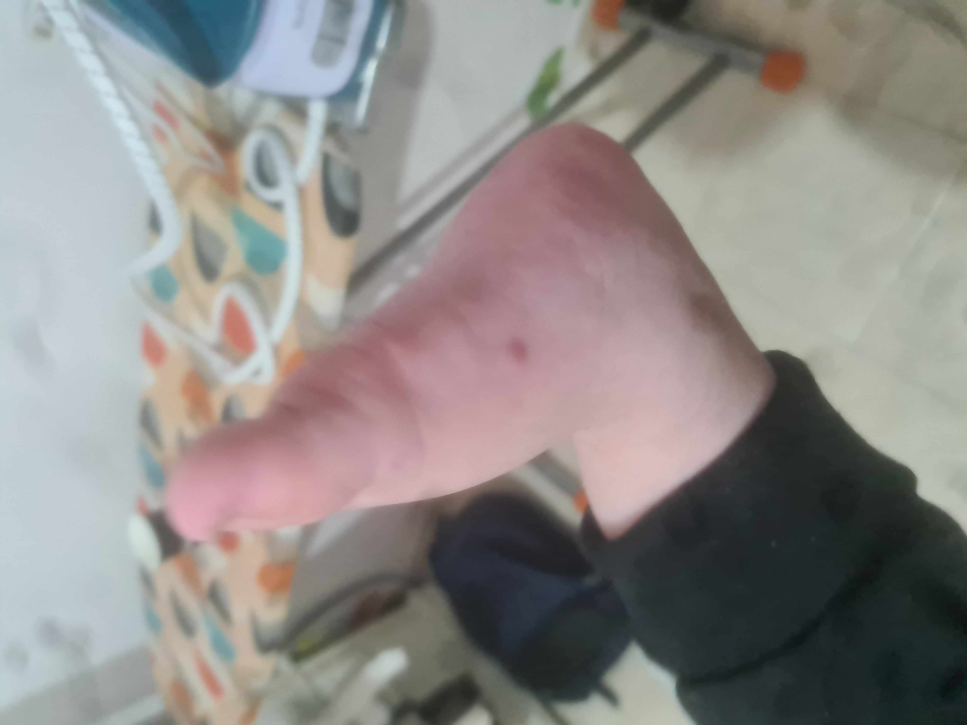 حبوب حمراء في قدم الطفل عمر 9 شهور