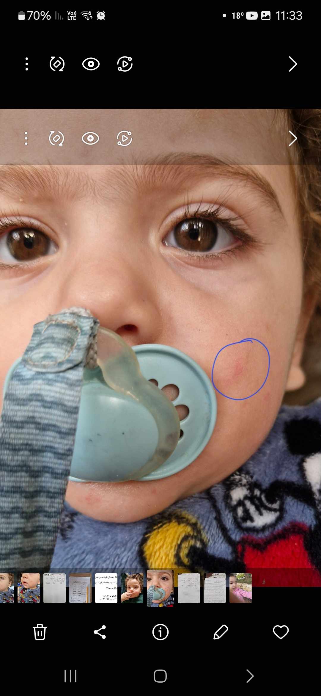 متى تزول آثار ندبات الخدوش؟