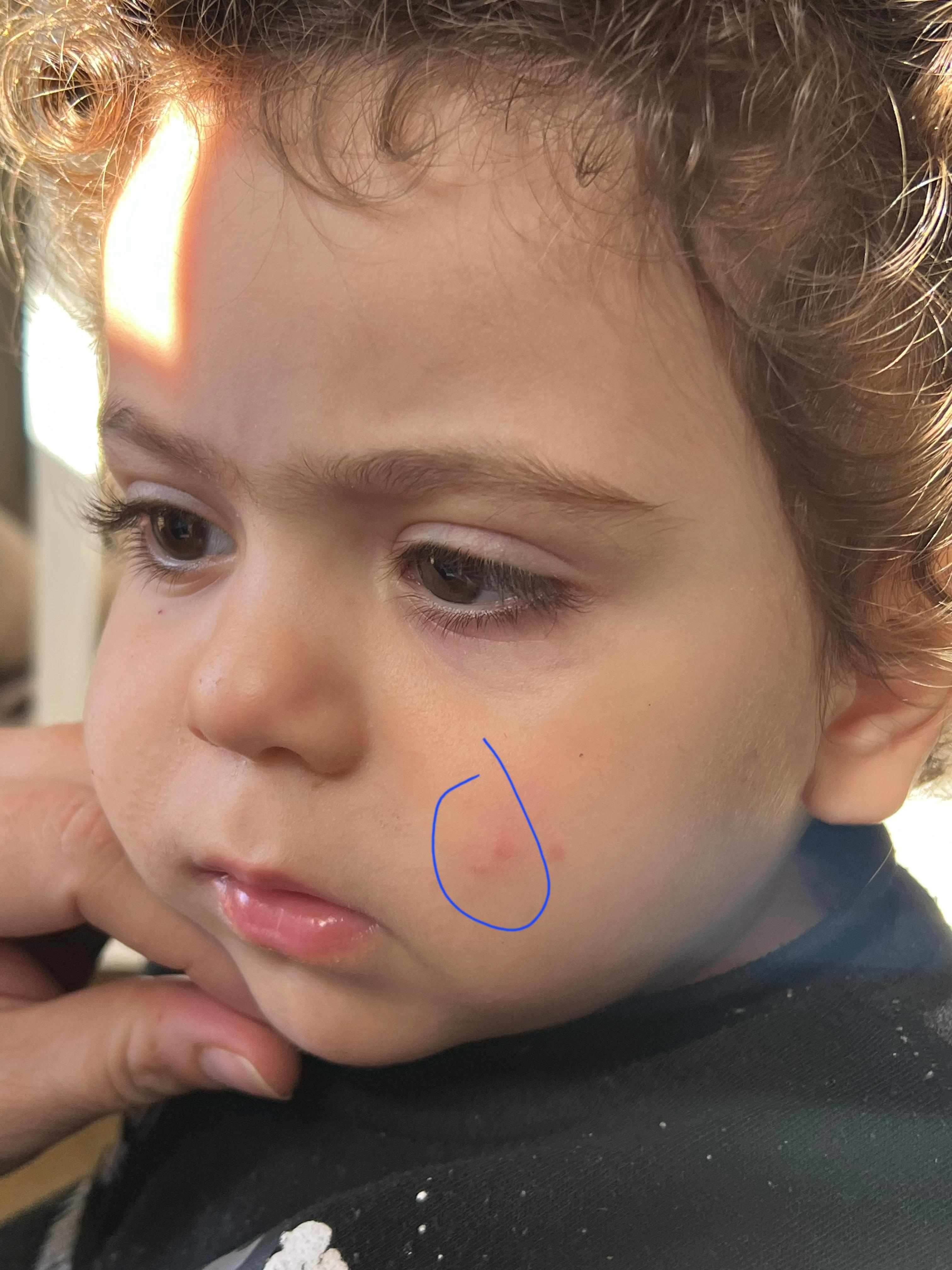 كم من الوقت تحتاج ندبة الوجه عند الطفل لتزول كلياً