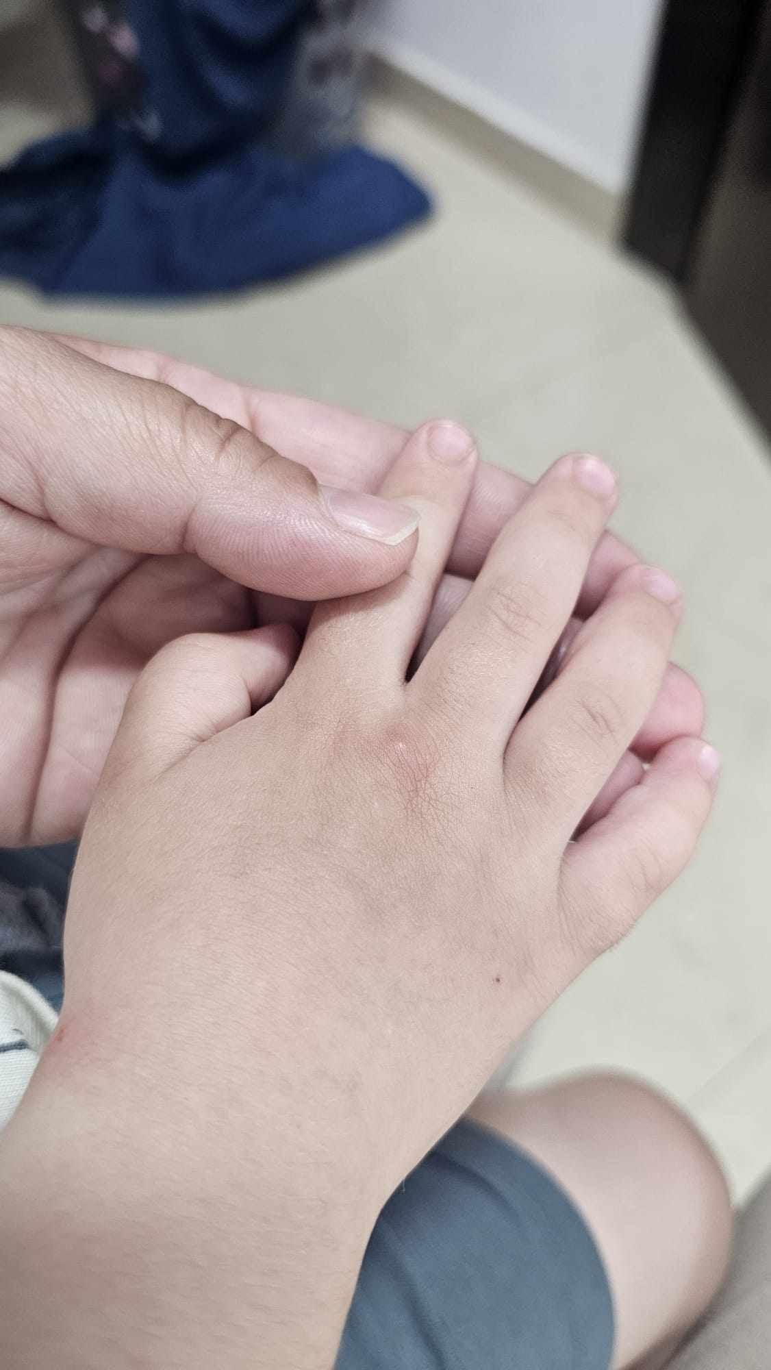 البهاق في بدايته